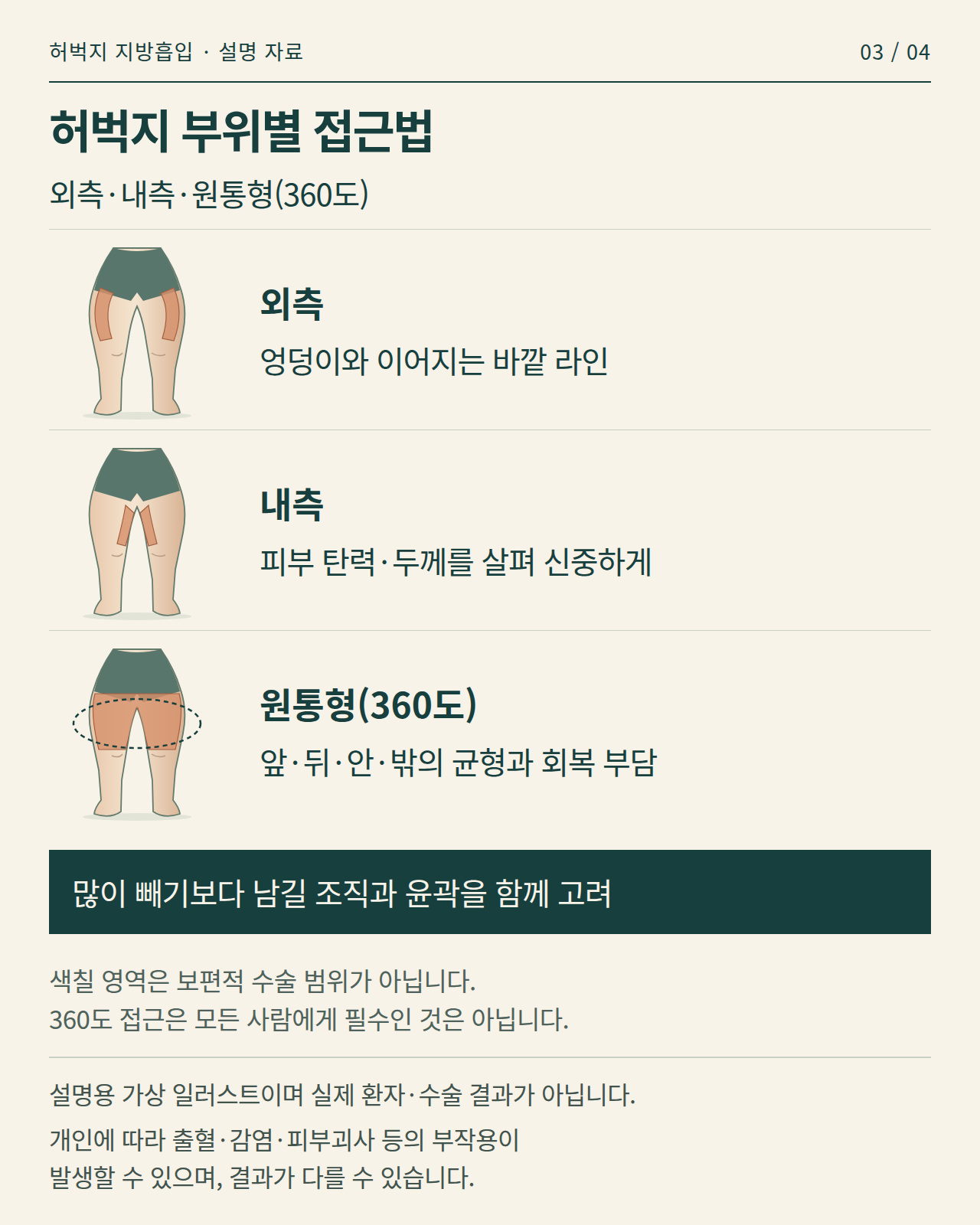 허벅지 외측·내측·원통형 접근법을 설명하는 가상 일러스트 인포그래픽