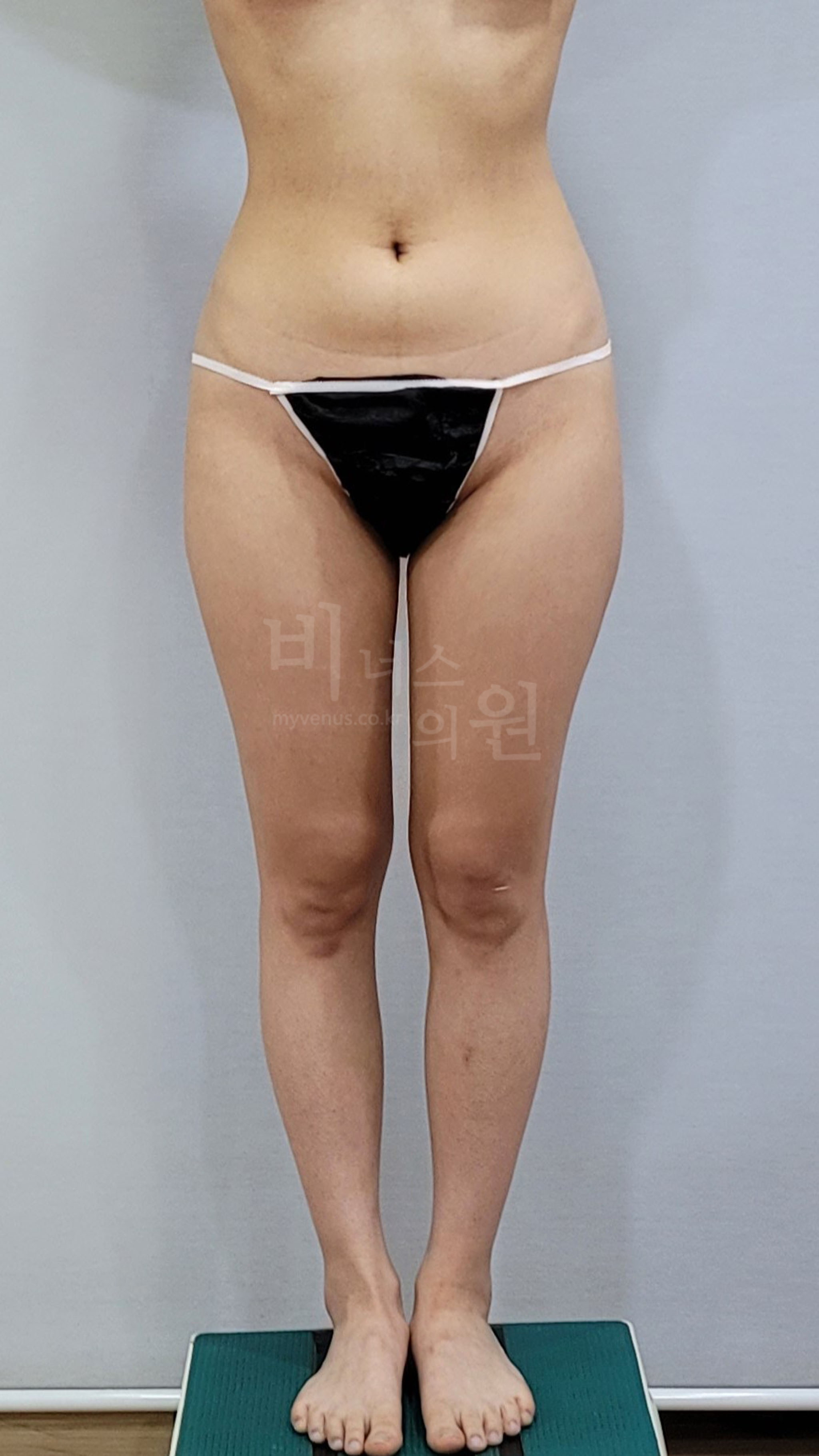 허벅지 지방흡입 수술 전 정면 비너스의원