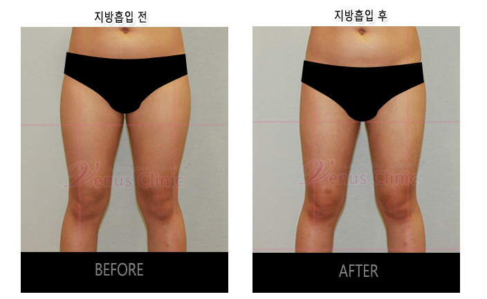 허벅지지방흡입5.jpg