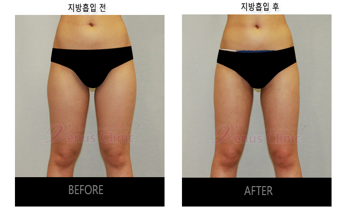 허벅지지방흡입1.jpg