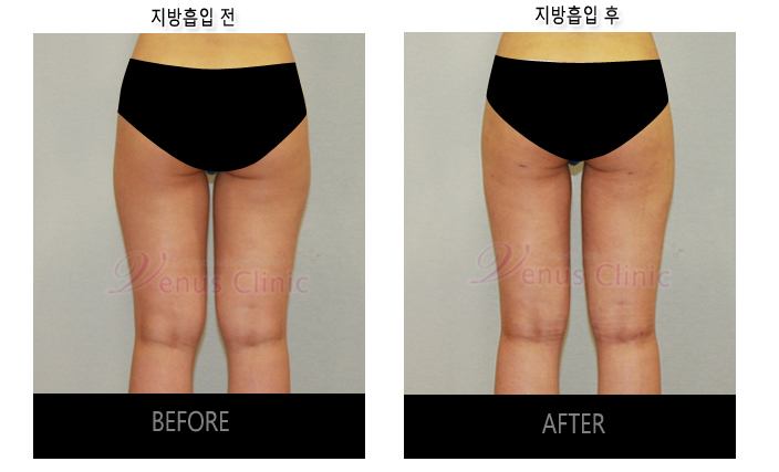 허벅지지방흡입3.jpg