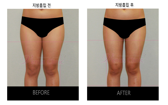 허벅지지방흡입4.jpg