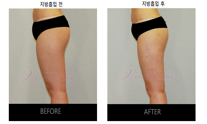 허벅지지방흡입2.jpg