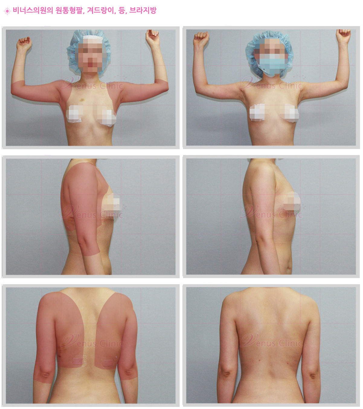 지방흡입 (3).jpg