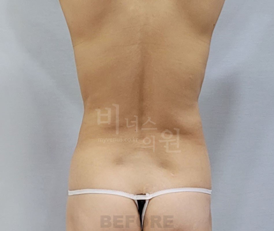 복부 지방흡입 수술 전