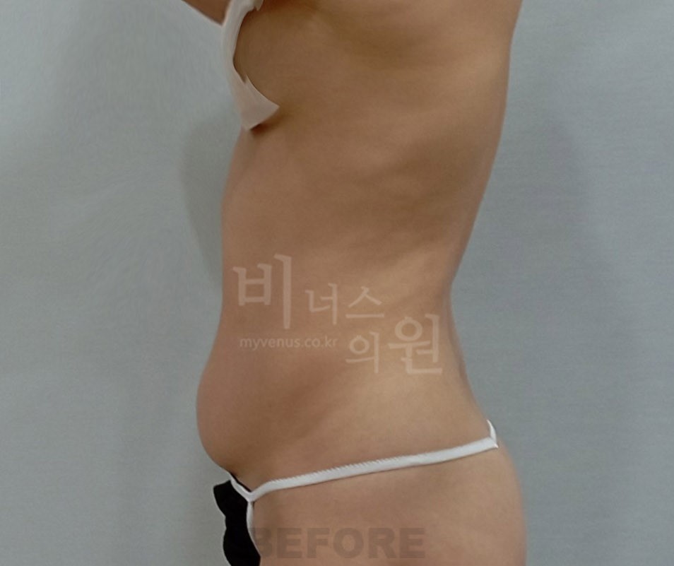 복부옆구리지방흡입_2 - 복사본.jpg