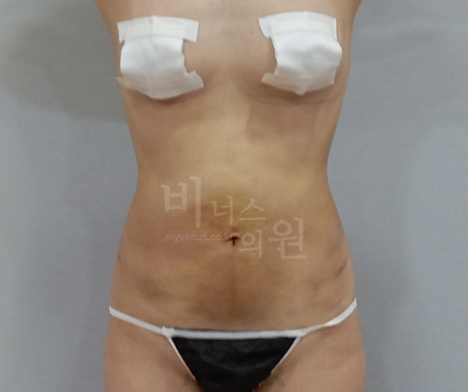 복부옆구리지방흡입_1 - 복사본.jpg