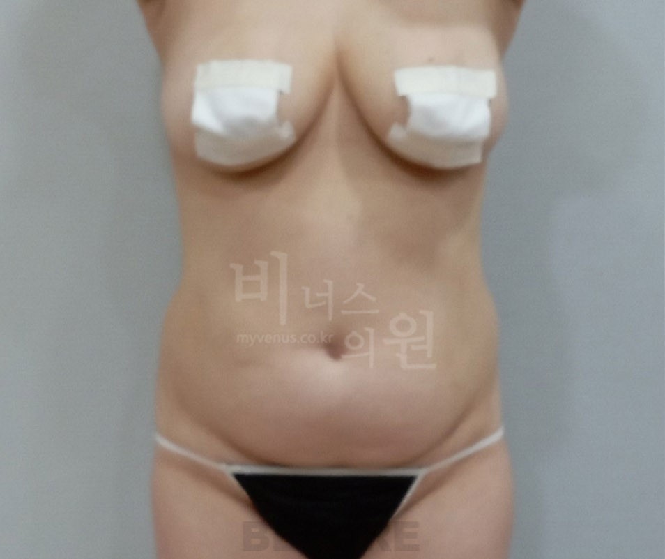 복부주름지방흡입_1.JPG