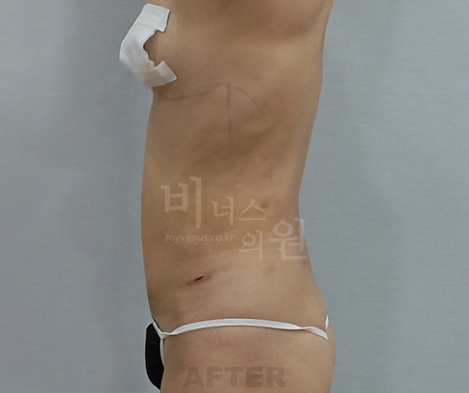복부옆구리지방흡입_2.jpg