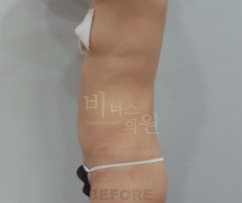 복부지방흡입_1 - 복사본.jpg