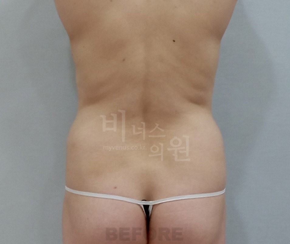 복부주름지방흡입_3 - 복사본.JPG