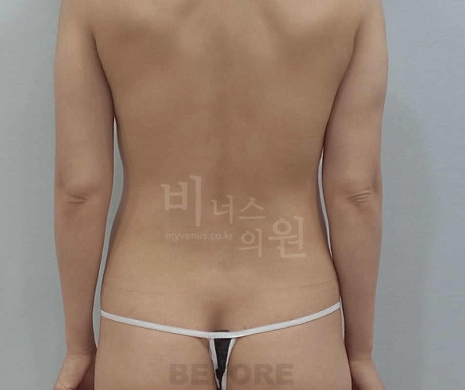 복부지방흡입_2 - 복사본.jpg