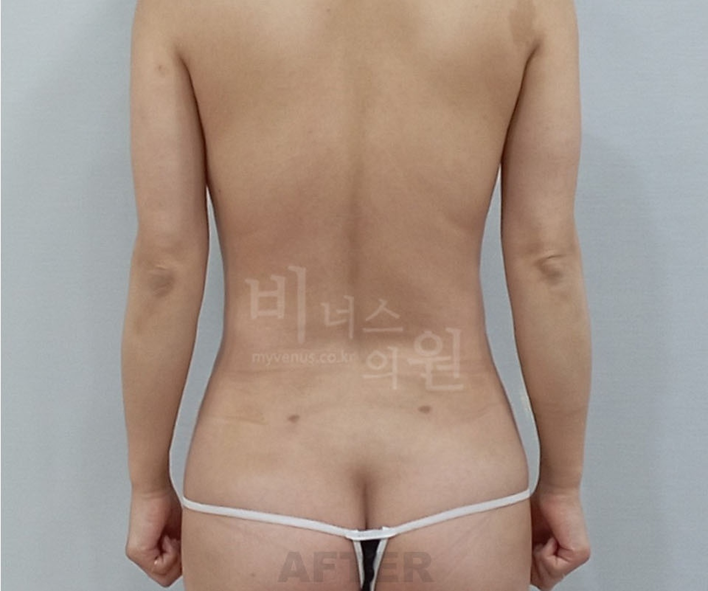 가슴축소수술 수술 후 후면 등 모습