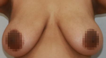 가슴 유방 축소 절개 지방흡입 효과 흉터.png