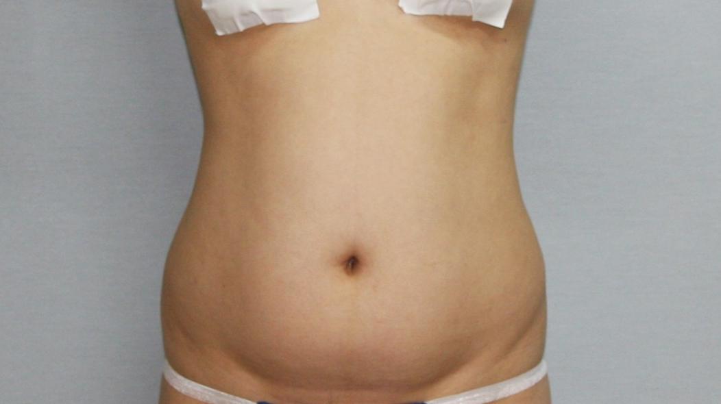 복부지방흡입 옆구리지방흡입 러브핸들지방흡입 앞배지방흡입 복부지방흡입부작용 복부지방흡입효과 복부지방흡입경과 복부지방흡입후기 복부지방흡입 피부처짐 복부탄력 복부뱃살빼기 복부지방흡입 부기 복부지방흡입 멍 복부지방흡입 관리 복부지방흡입 흉터 복부지방흡입결과 복부지방흡입핀치테스트.jpg