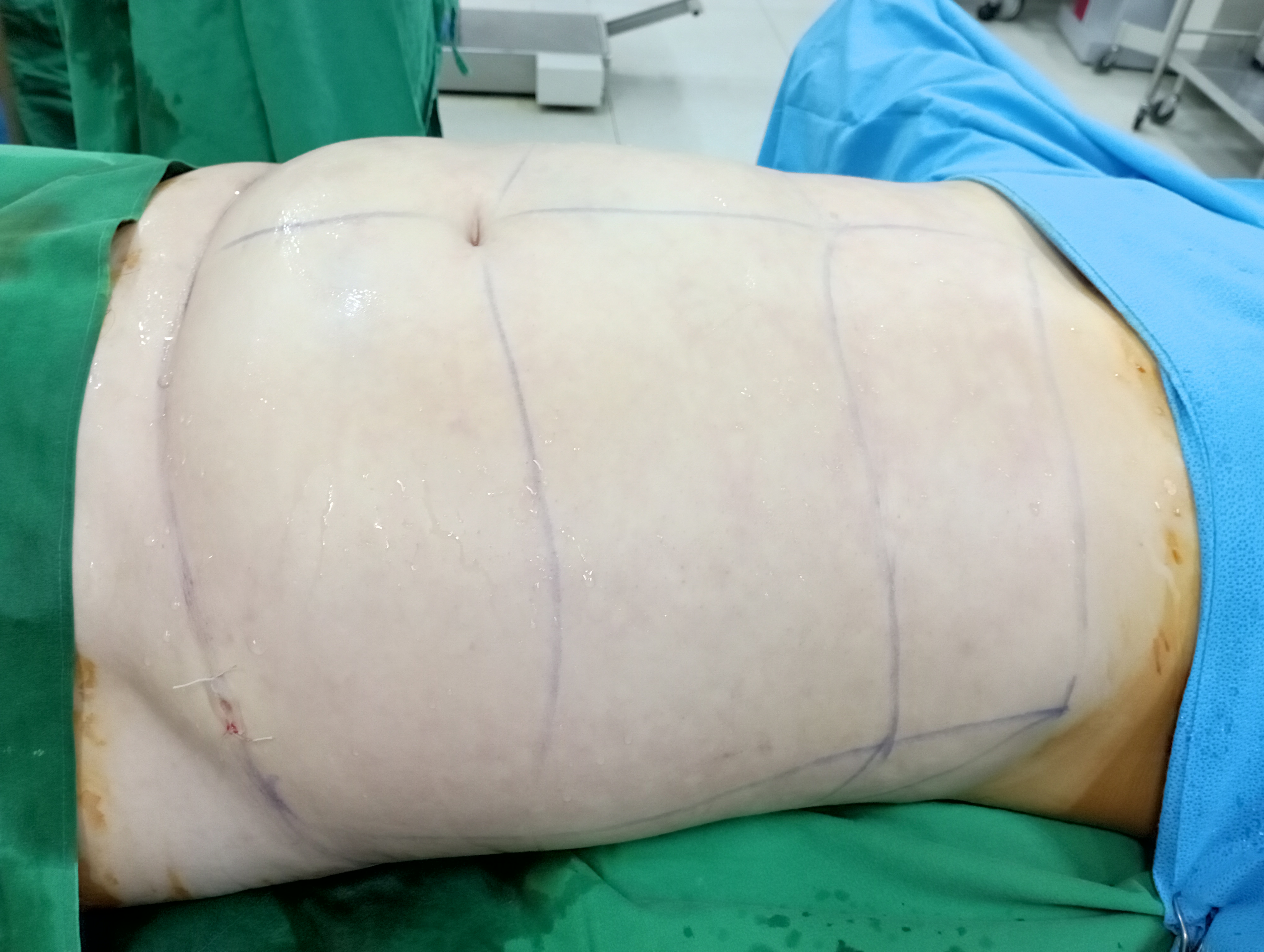 부천지방흡입 복부.jpg