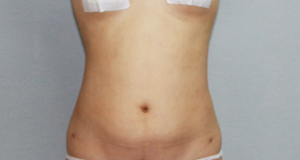 뱃살지방흡입 복부지방흡입 옆구리지방흡입 러브핸들지방흡입 앞배지방흡입 복부지방흡입부작용 복부지방흡입효과 복부지방흡입경과 복부지방흡입후기 복부지방흡입 피부처짐 복부탄력 복부뱃살빼기 복부지방흡입 부기 복부지방흡입 멍 복부지방흡입 관리 복부지방흡입 흉터 복부지방흡입결과 복부지방흡입핀치테스트.jpg