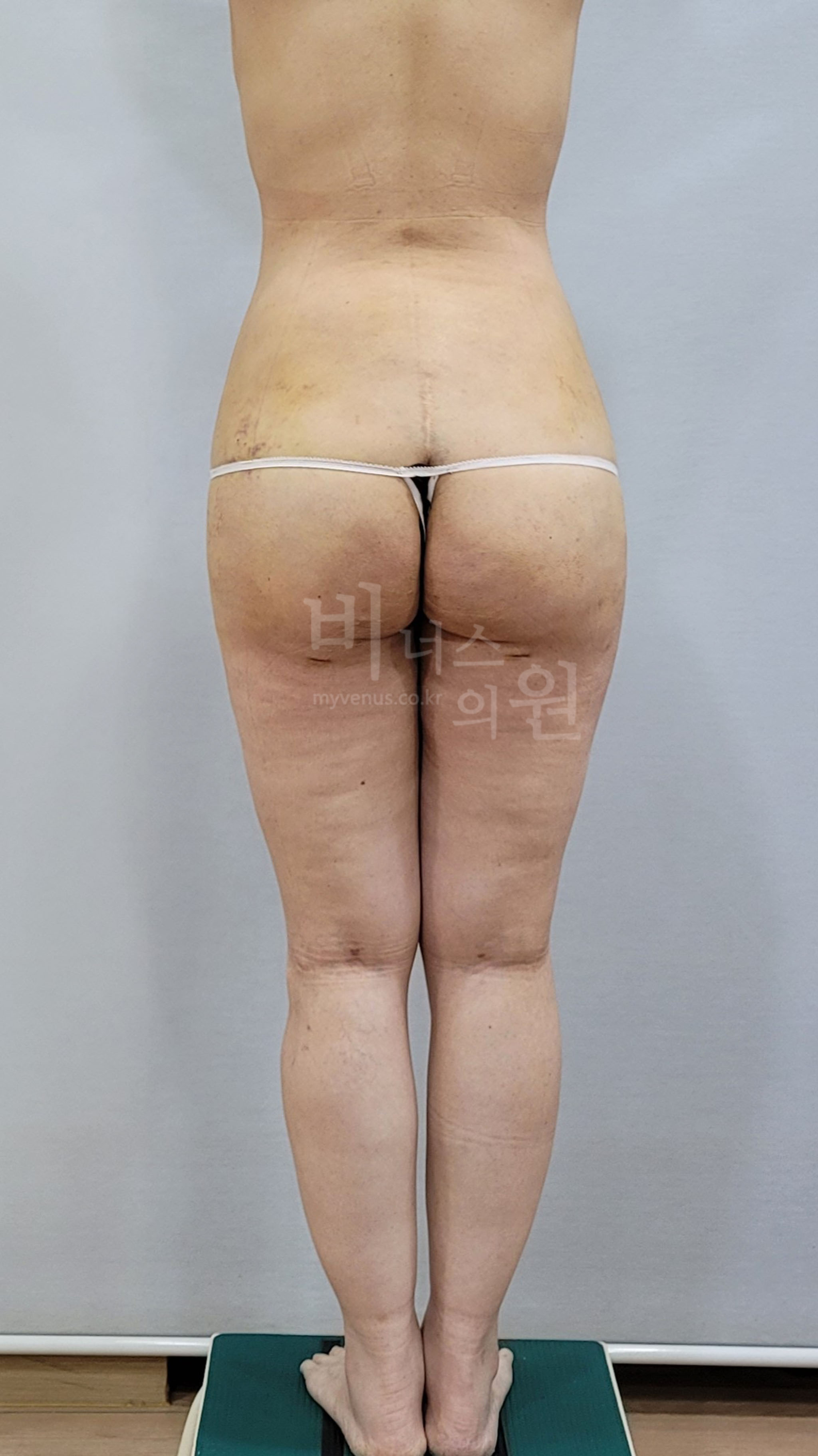 엉덩이축소 지방흡입 수술 후 1주 후면 비너스의원