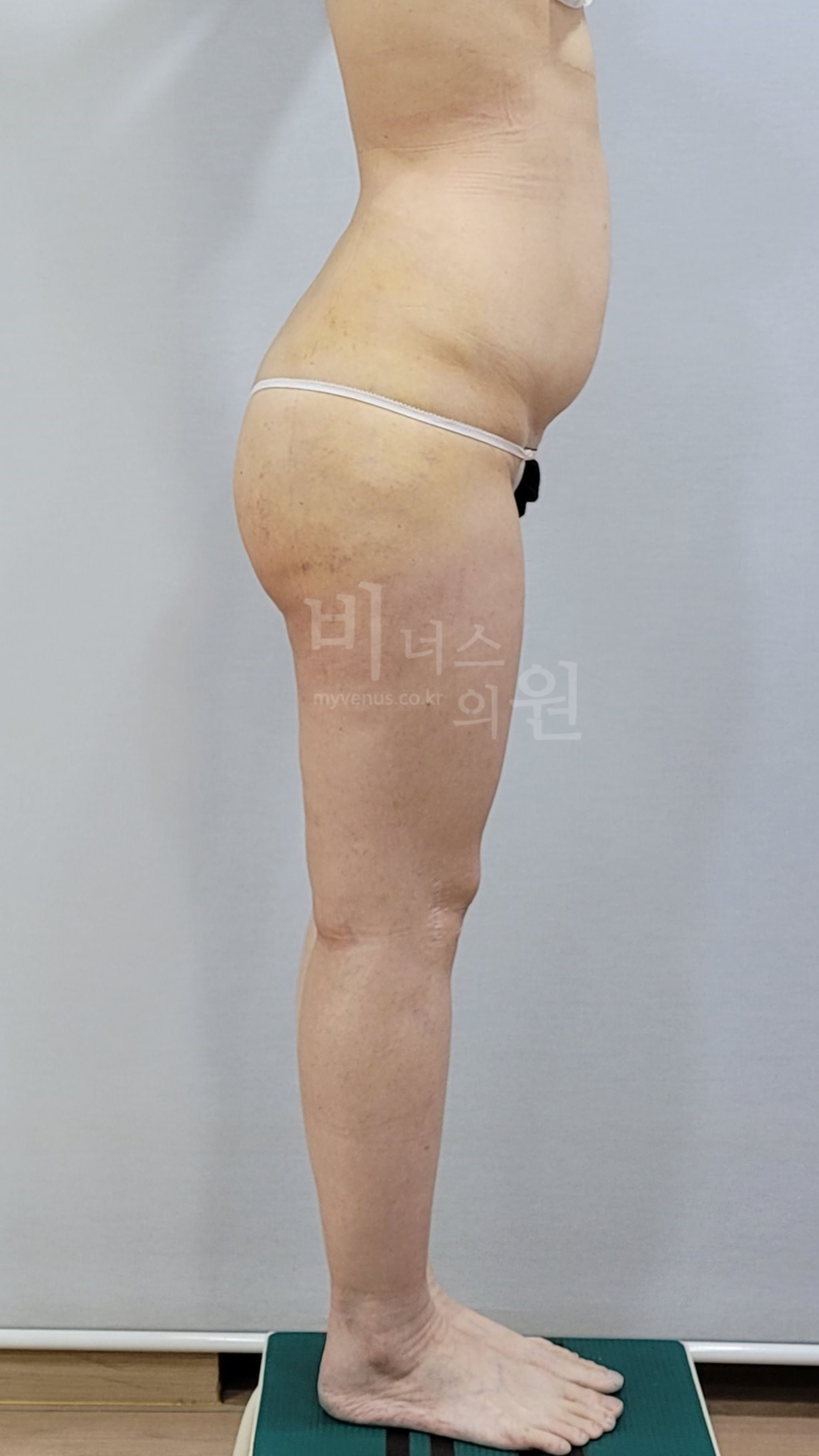 엉덩이축소 지방흡입 수술 후 1주 좌측면 비너스의원
