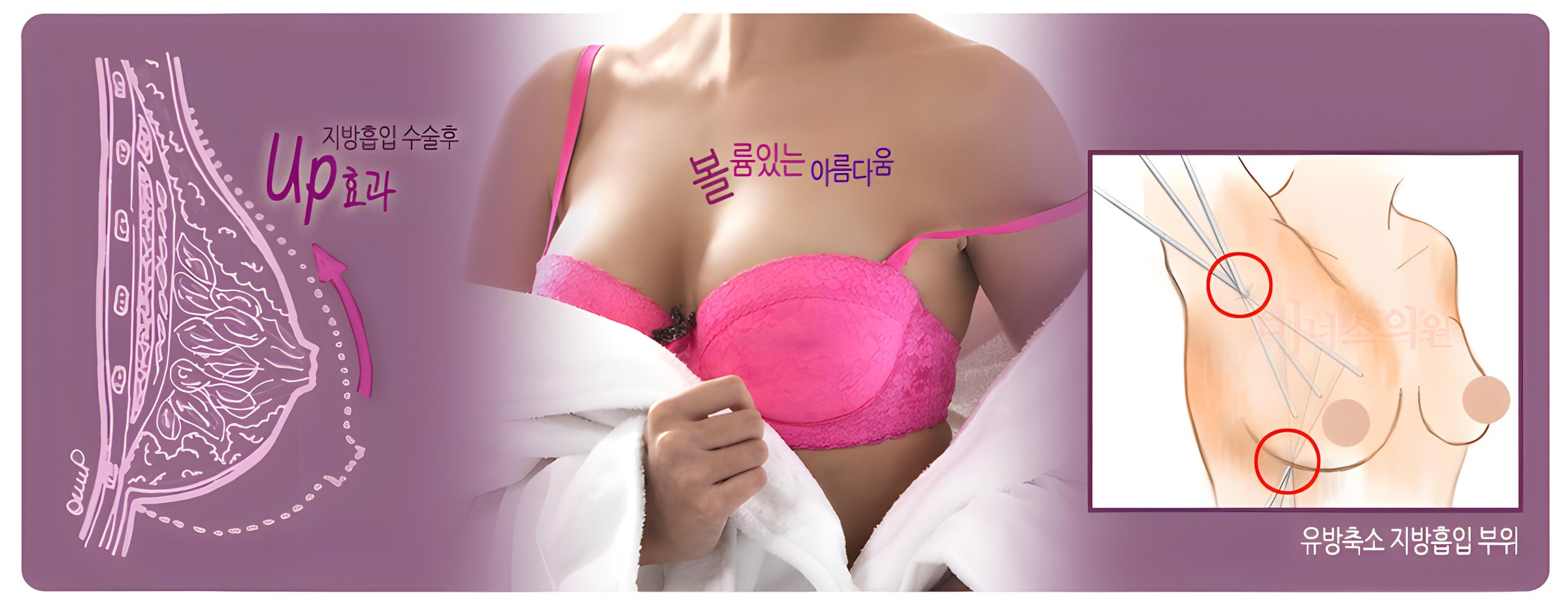 가슴 수술 회복 지방흡입 과정 비너스의원