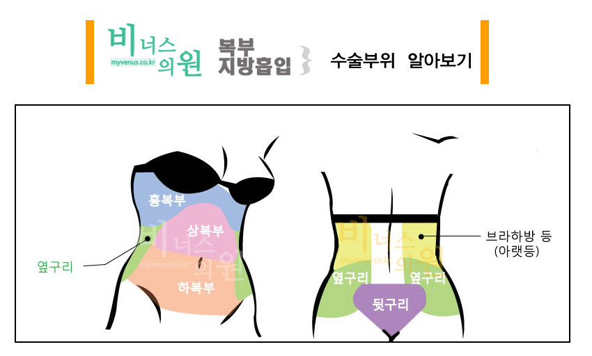 비너스의-복부지방흡입-부위-섹션.jpg