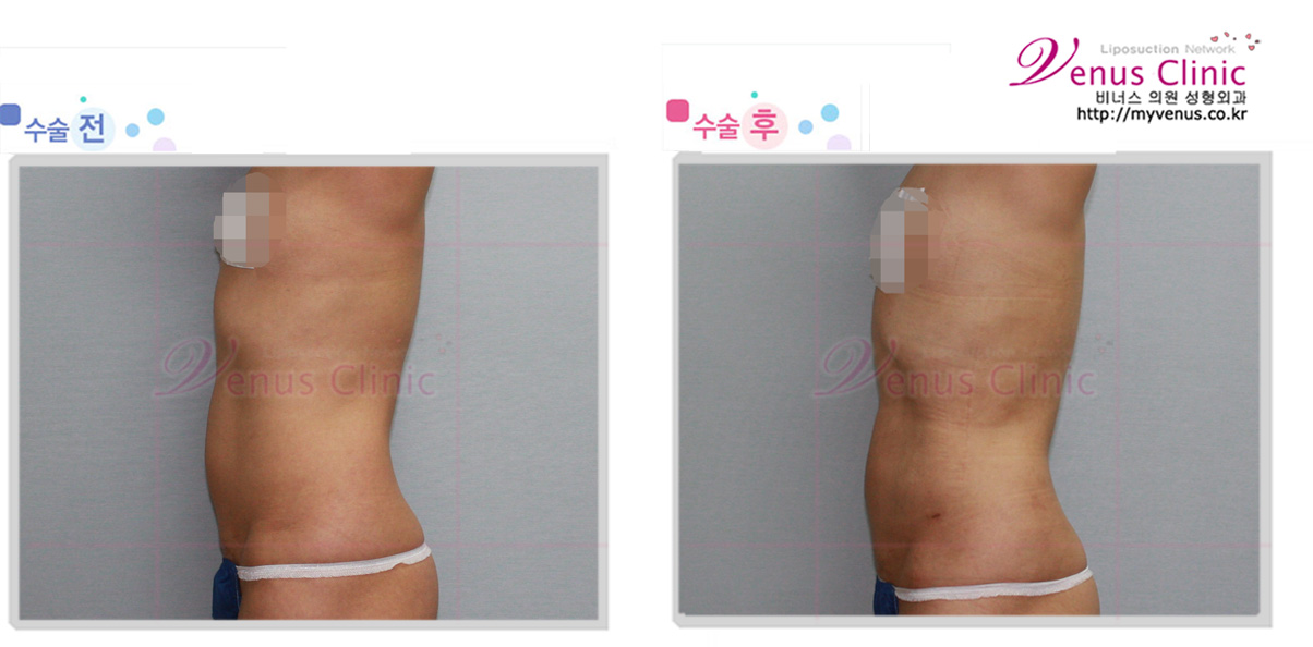 지방흡입 (1).jpg