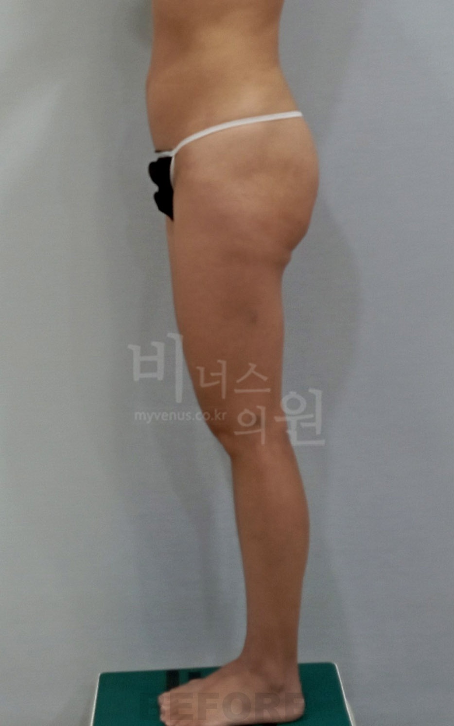 엉덩이 지방흡입 수술 전 측면 비너스의원