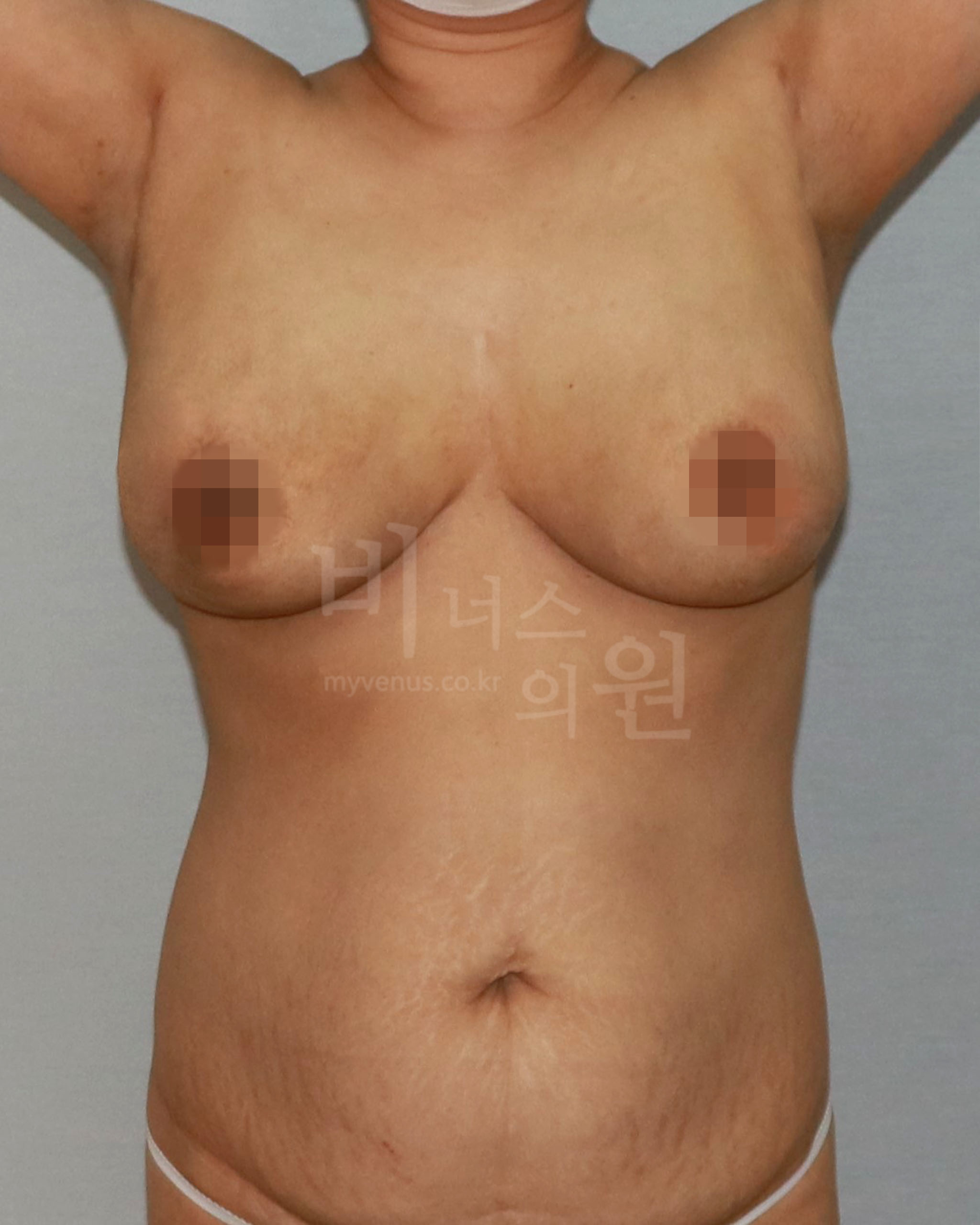 가슴축소 지방흡입 수술 후 정면 비너스의원