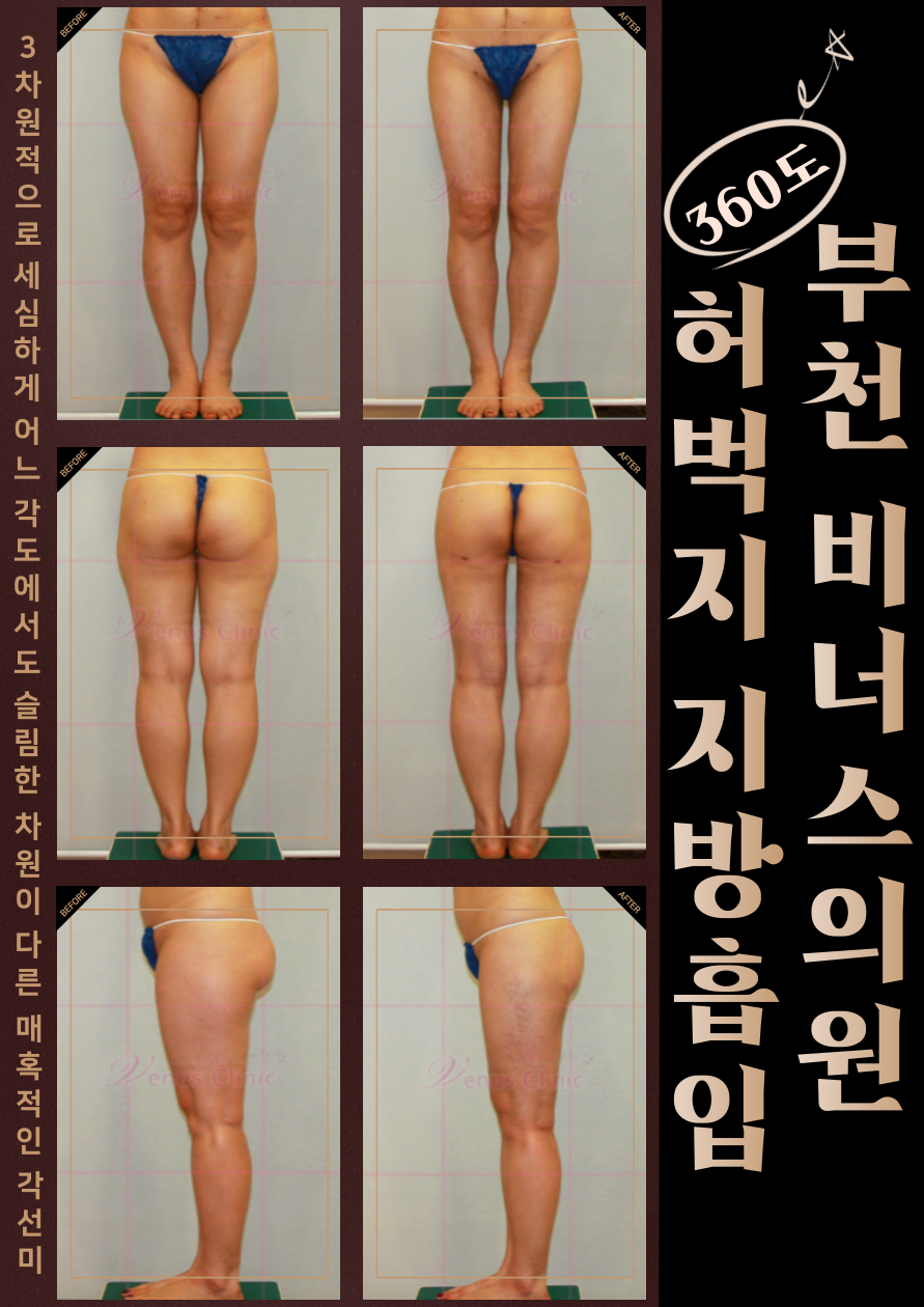 허벅지지방흡입-008.png