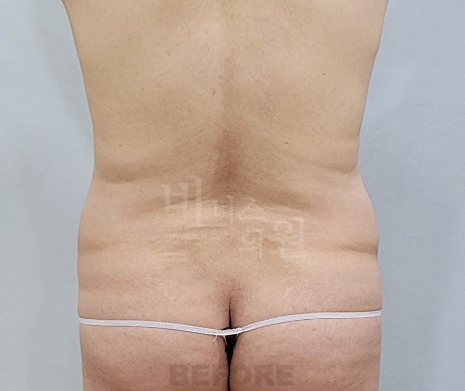 복부 지방흡입 수술 전 후면 비너스의원