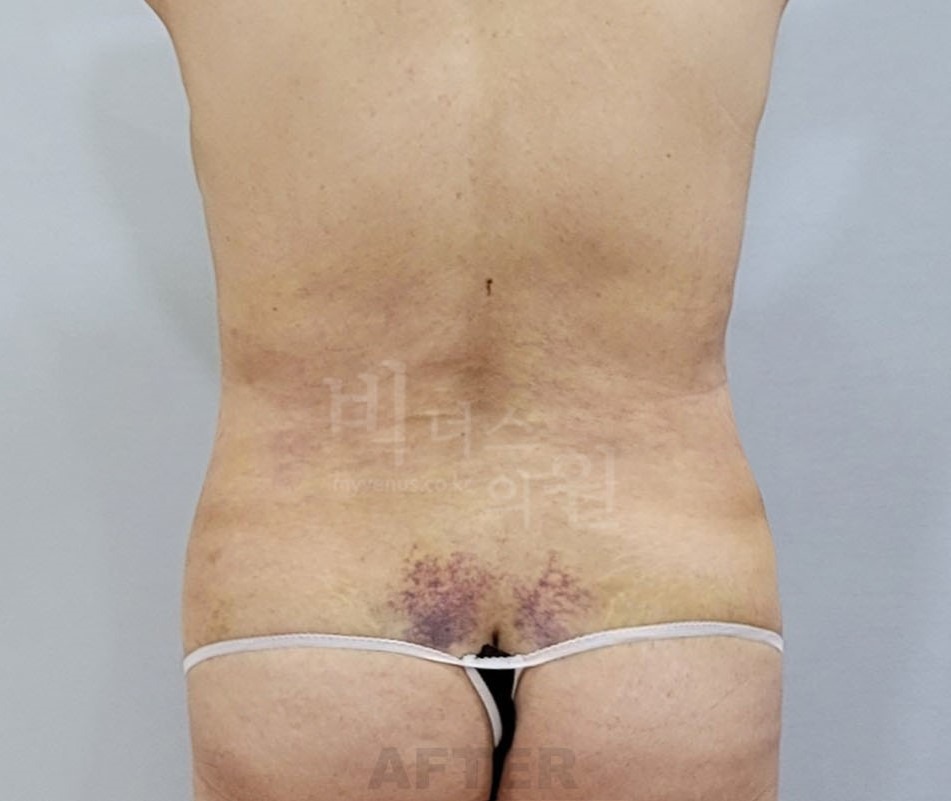 복부 지방흡입 수술 후 후면 비너스의원