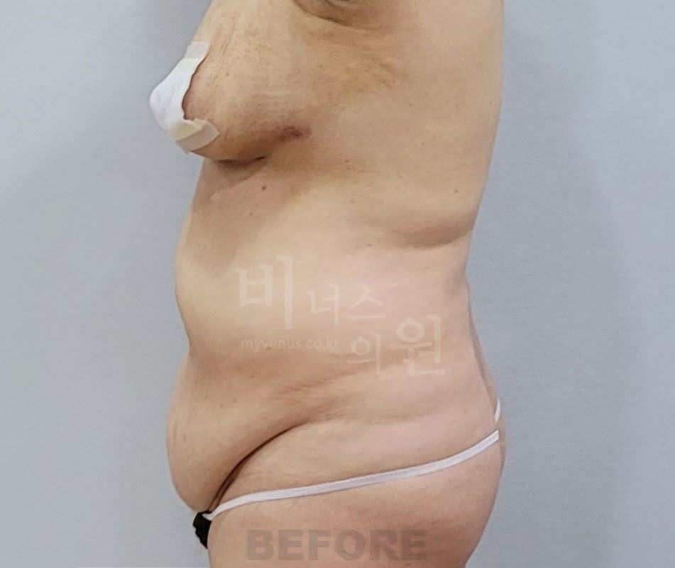 복부 지방흡입 수술 전 측면 비너스의원