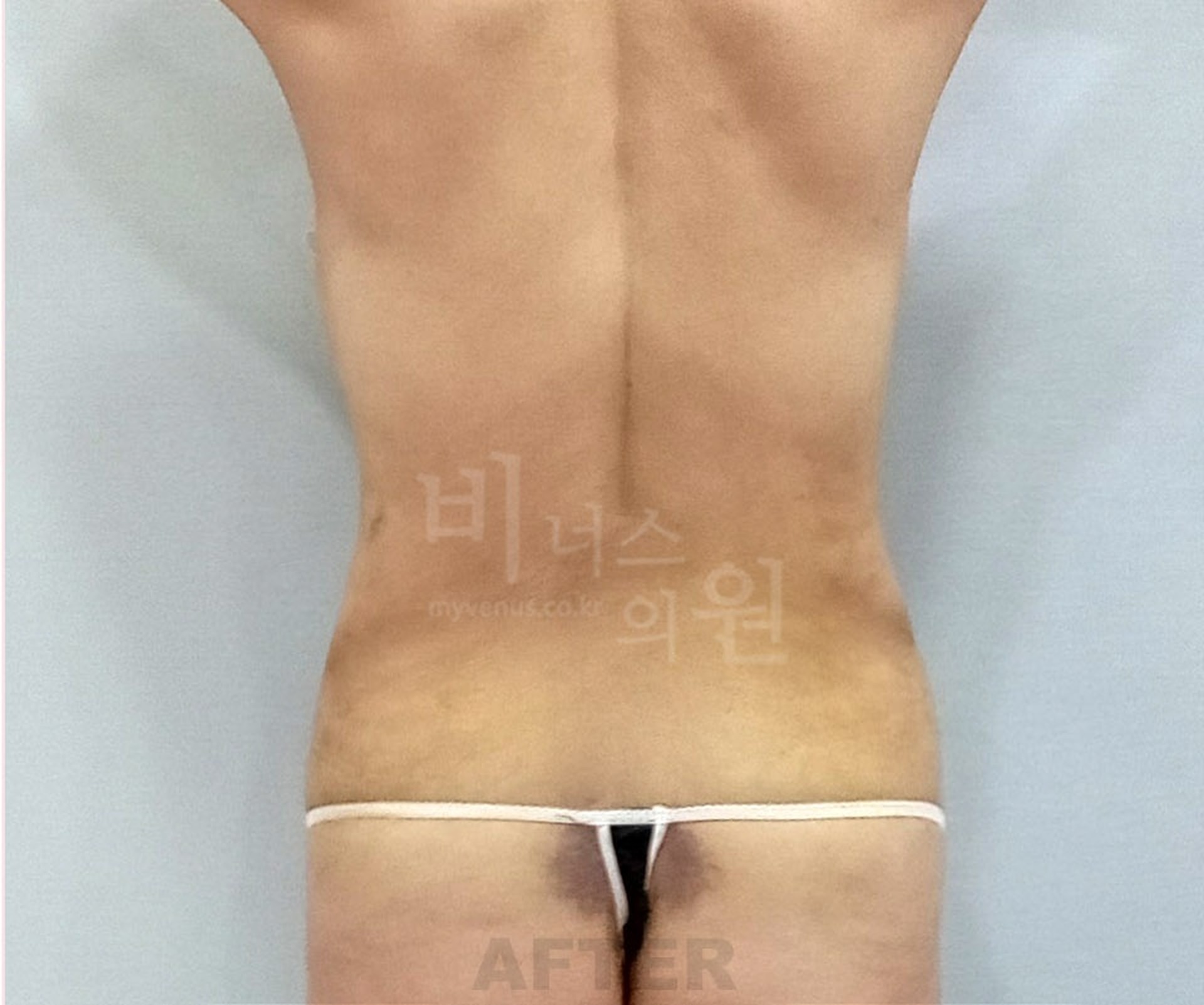 복부 지방흡입 수술 후 후면 비너스의원