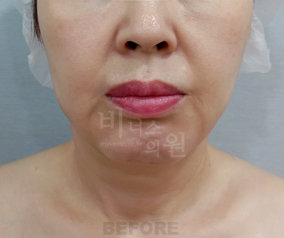 이중턱 목 지방흡입 수술 전 정면 비너스의원