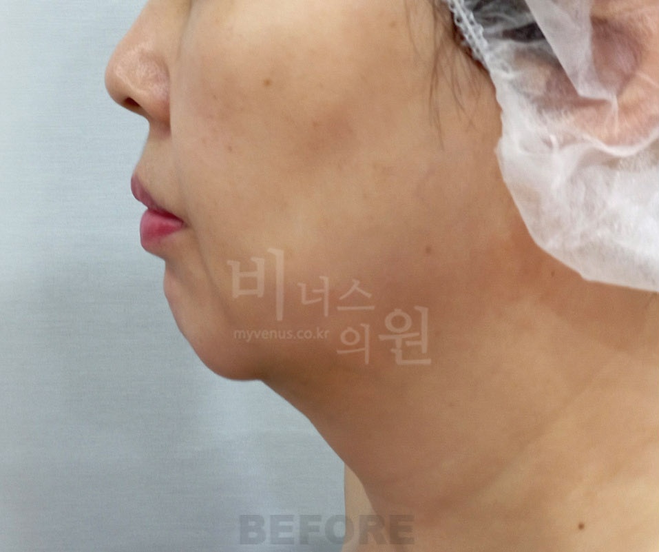 이중턱 목 지방흡입 수술 전 측면 비너스의원