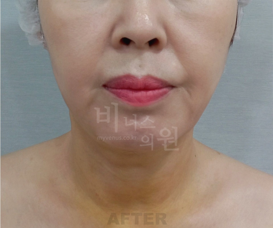 이중턱 목 지방흡입 수술 후 정면 비너스의원