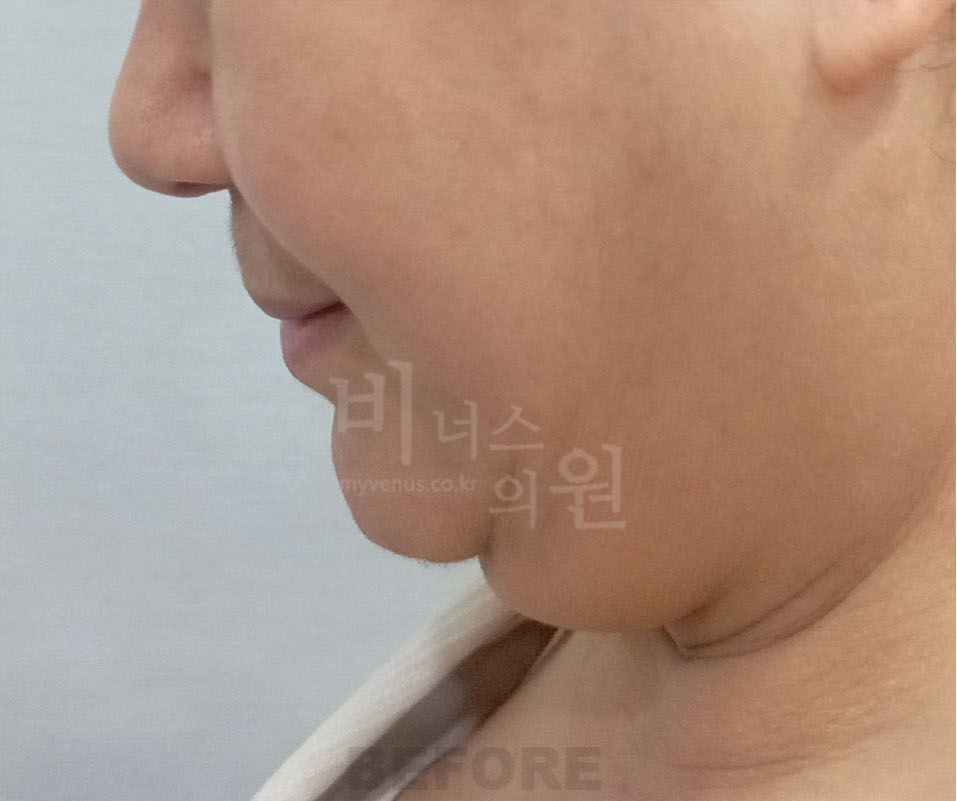 턱지방흡입 수술 전 측면 비너스의원