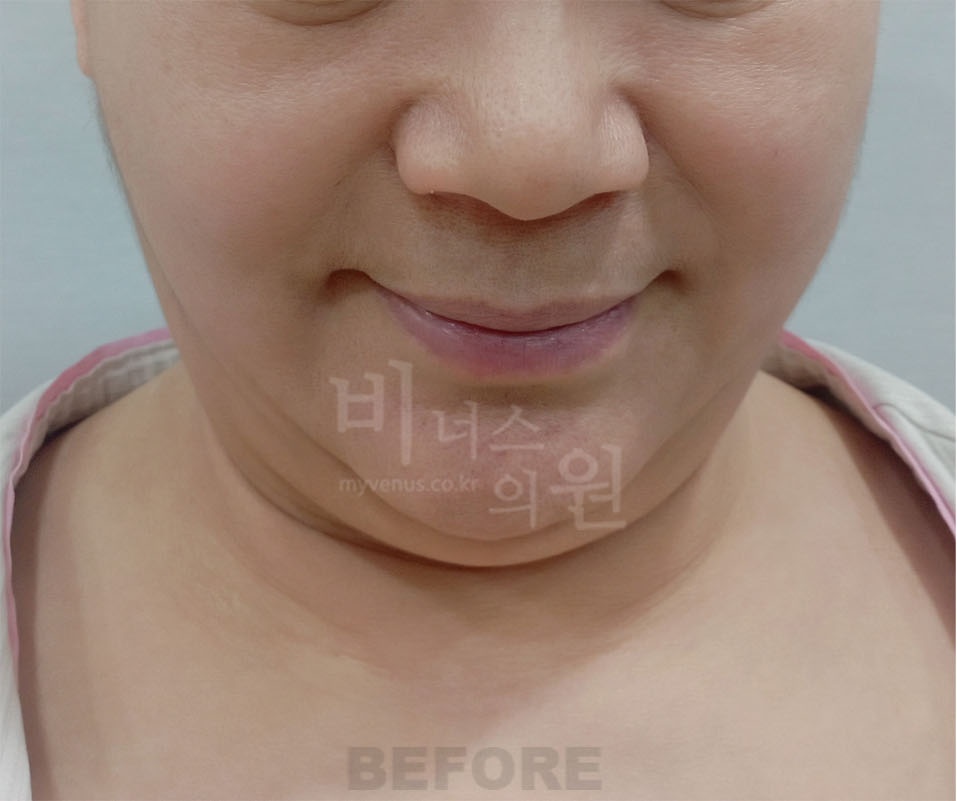 턱지방흡입 수술 전 정면 비너스의원