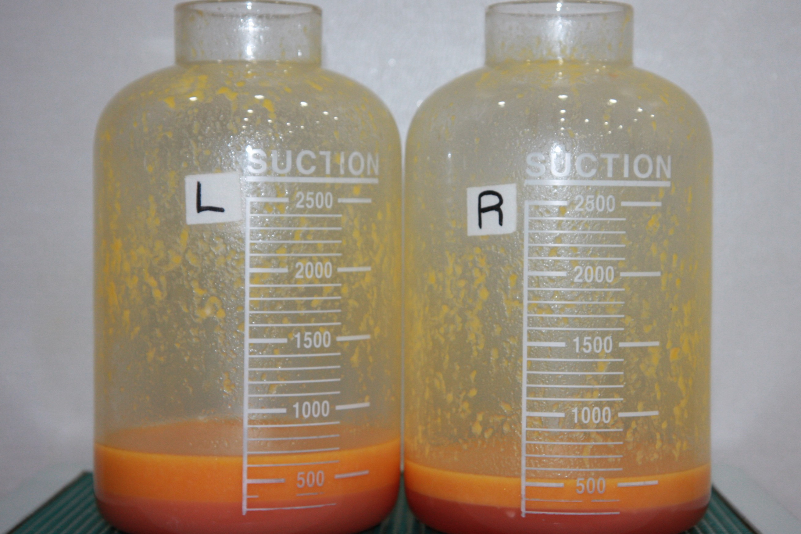 힙업 골반 지방이식 지방채취 엉덩이주름 엉덩이볼륨 지방채취량 지방이식량.jpg