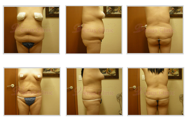 대용량지방흡입후 피부수축 전후사진