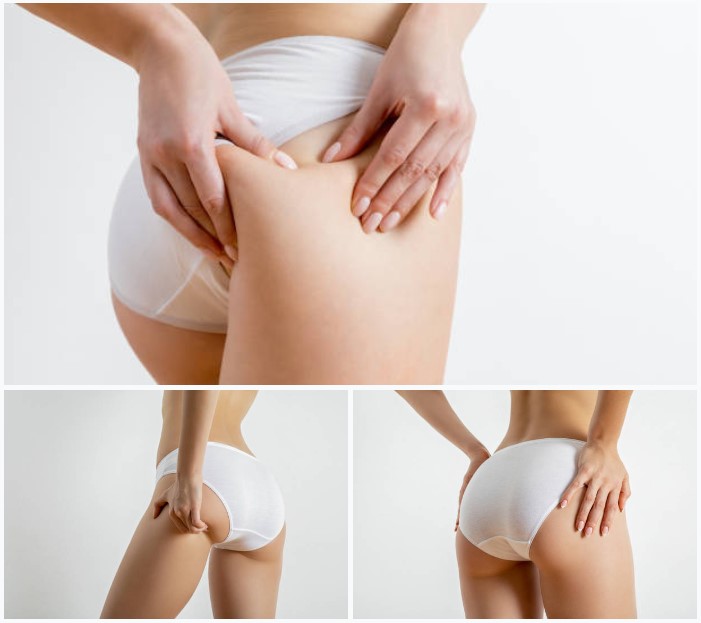 엉덩이지방이식 엉덩이확대 엉덩이확대지방이식 엉덩이주름지방이식 엉덩이볼륨업지방이식 엉덩이지방흡입 골반지방이식 엉덩이성형 엉덩이지방이식전후경과 엉덩이지방이식전후부기 엉덩이지방이식후기 엉덩이지방이식생착률.jpg