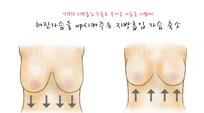 가슴지방흡입2.jpg