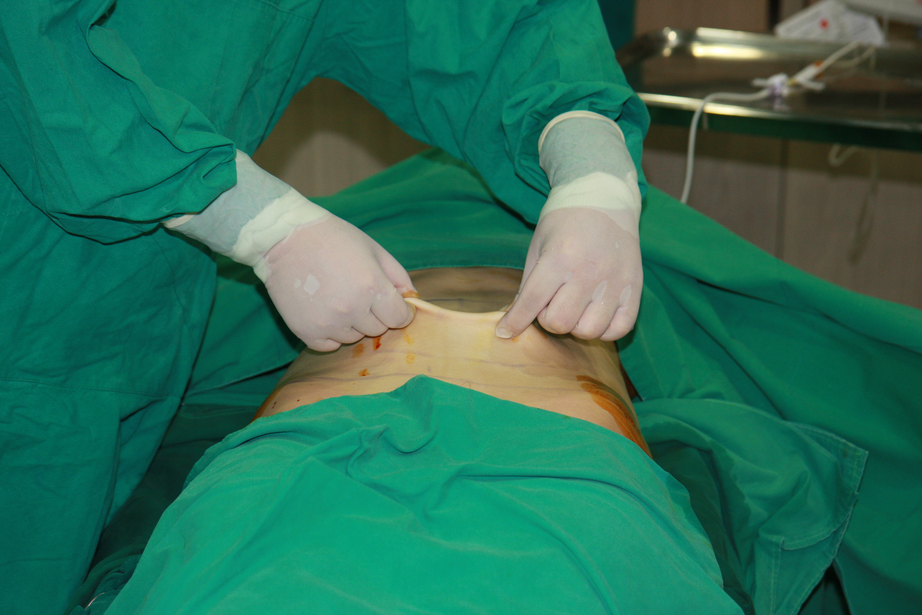 복부지방흡입 뱃살지방흡입 결과 효과 부작용 요요JPG