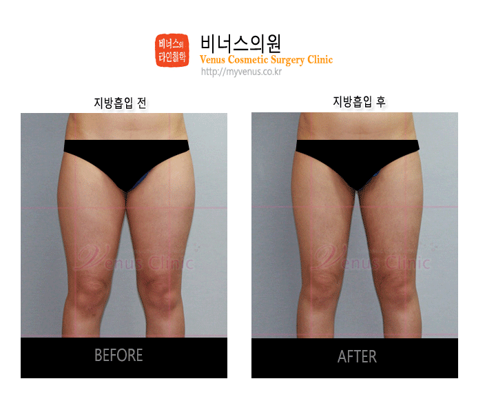 허벅지지방흡입3.gif