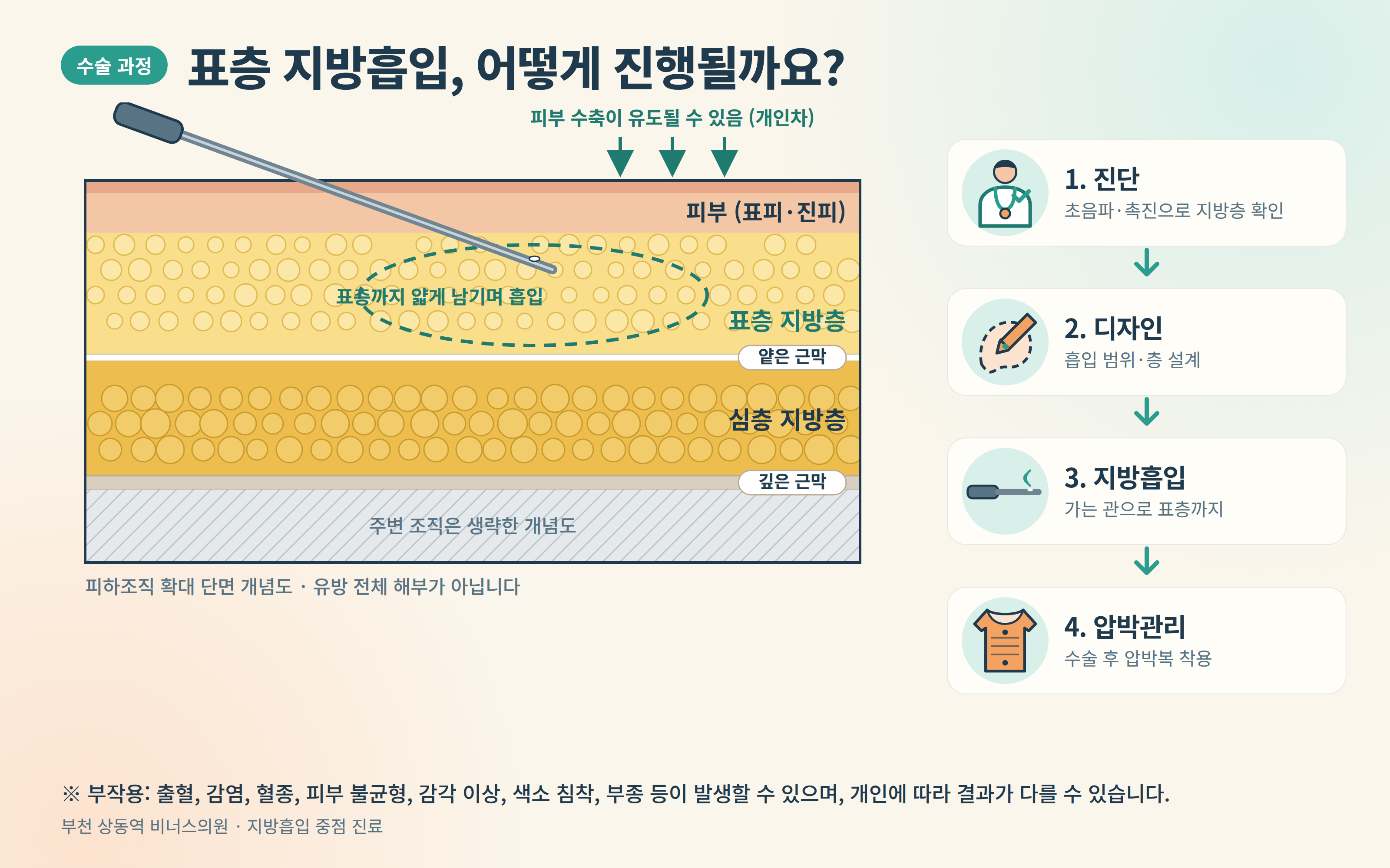 표층 지방흡입 유방축소 수술 4단계 과정 인포그래픽