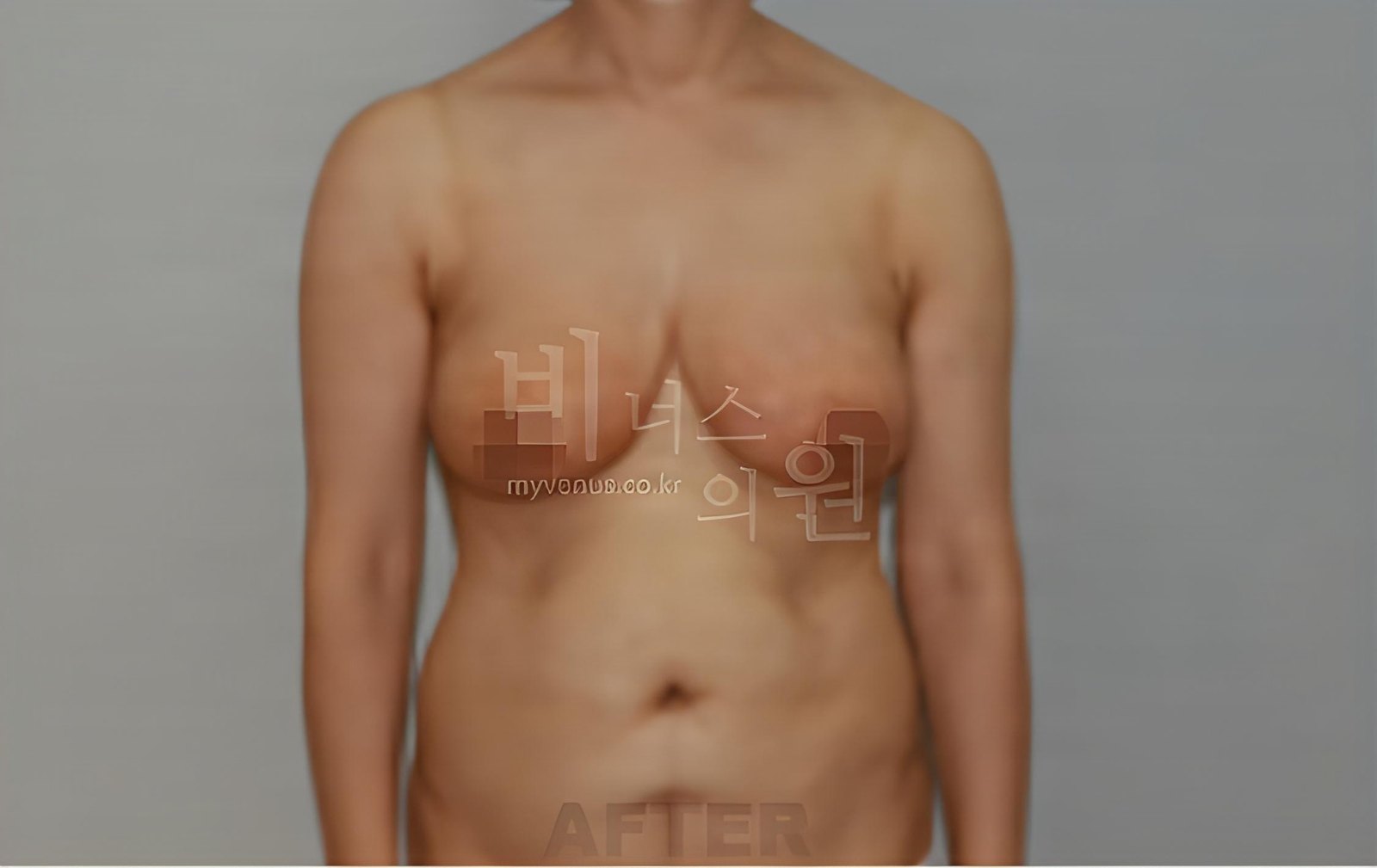 유방하수 가슴 지방흡입 수술 후 정면 비너스의원