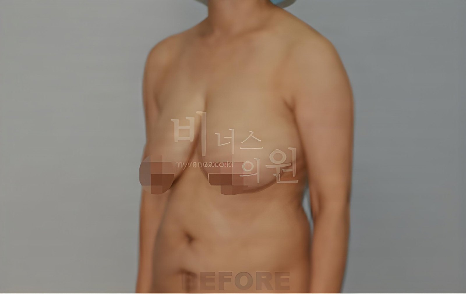 유방하수 가슴 지방흡입 수술 전 45도 측면 비너스의원