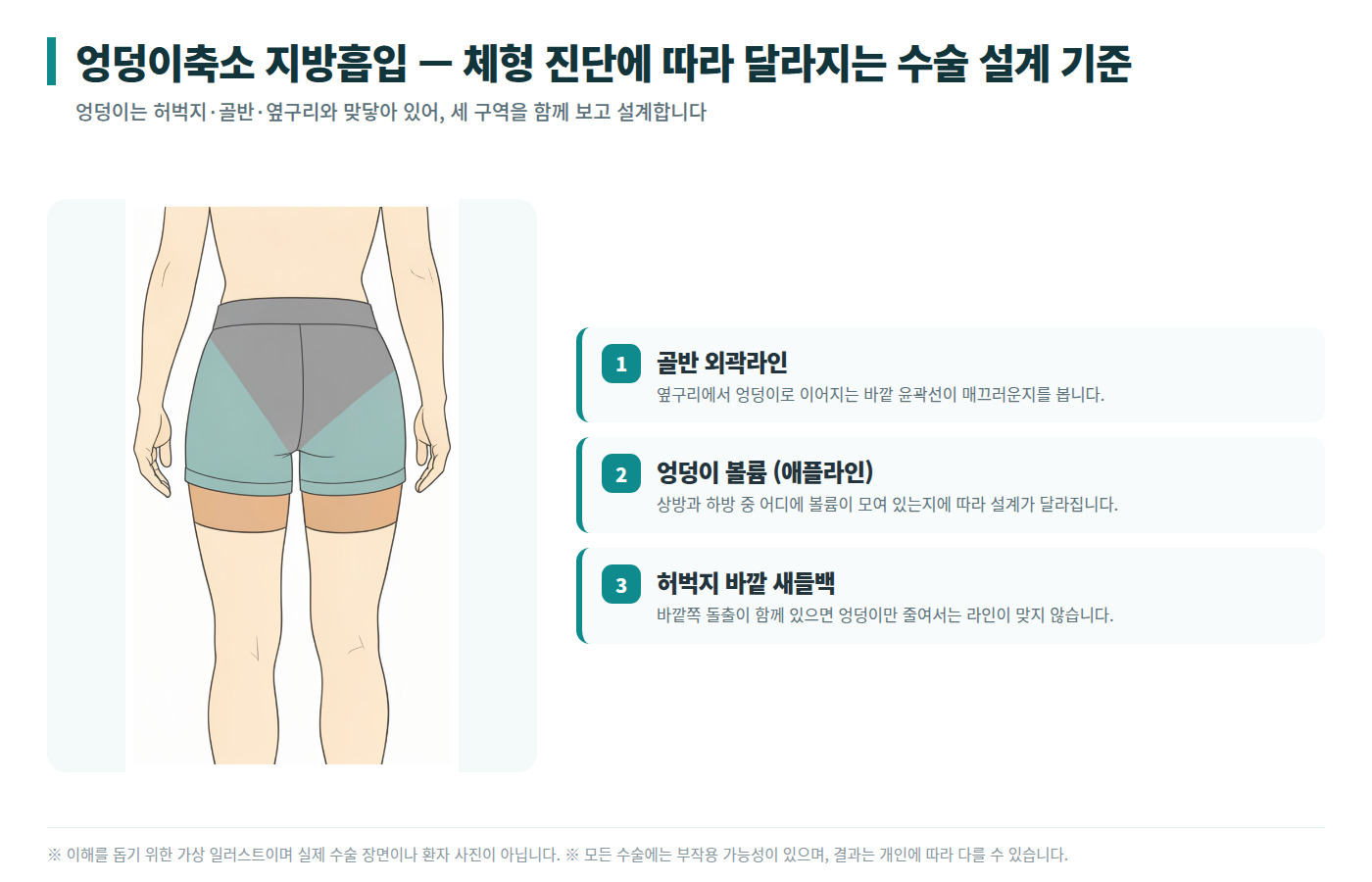엉덩이축소 지방흡입 체형 진단 구역 인포그래픽 — 골반 외곽라인·엉덩이 볼륨·허벅지 새들백