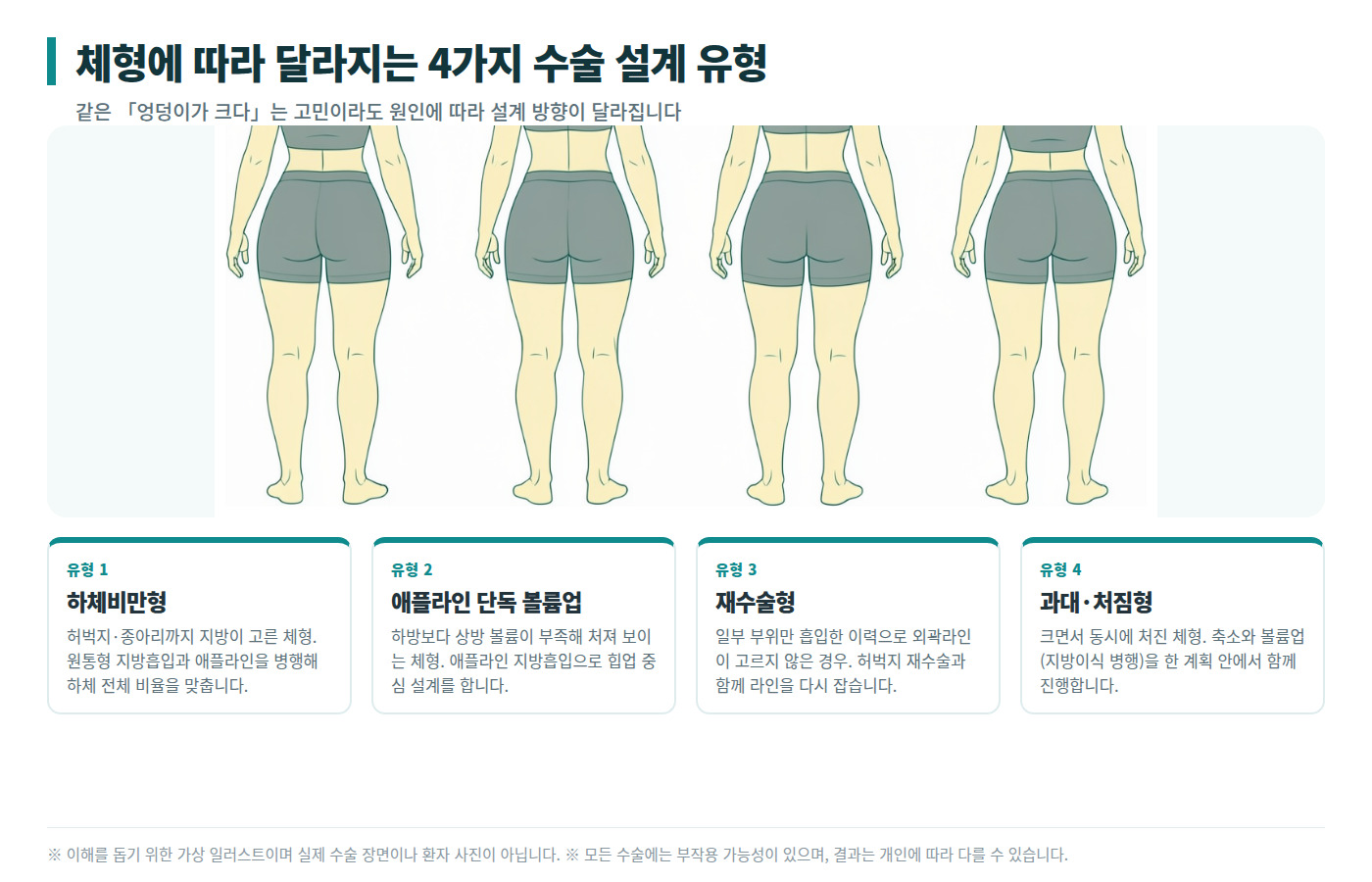 엉덩이축소 지방흡입 4가지 수술 설계 유형 인포그래픽 — 하체비만형·애플라인 볼륨업·재수술형·과대 처짐형