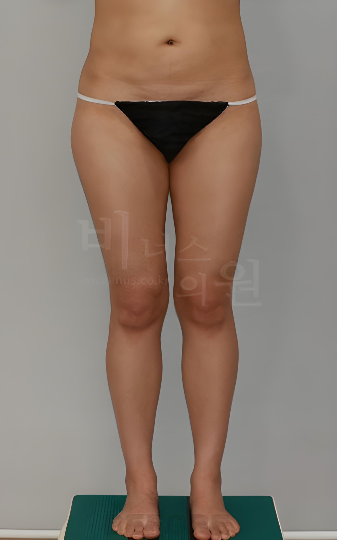 엉덩이 애플라인 지방흡입 수술 전 정면